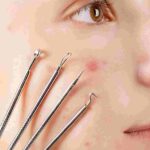 Adult acne solutions with dermatologist care and herbal remedies